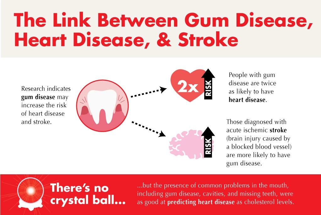 The link between gum disease and stroke.