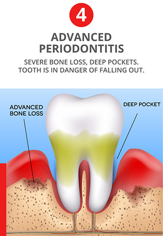 Advanced Periodontitis - Severe bone loss, deep pockets. Tooth is in danger of falling out.