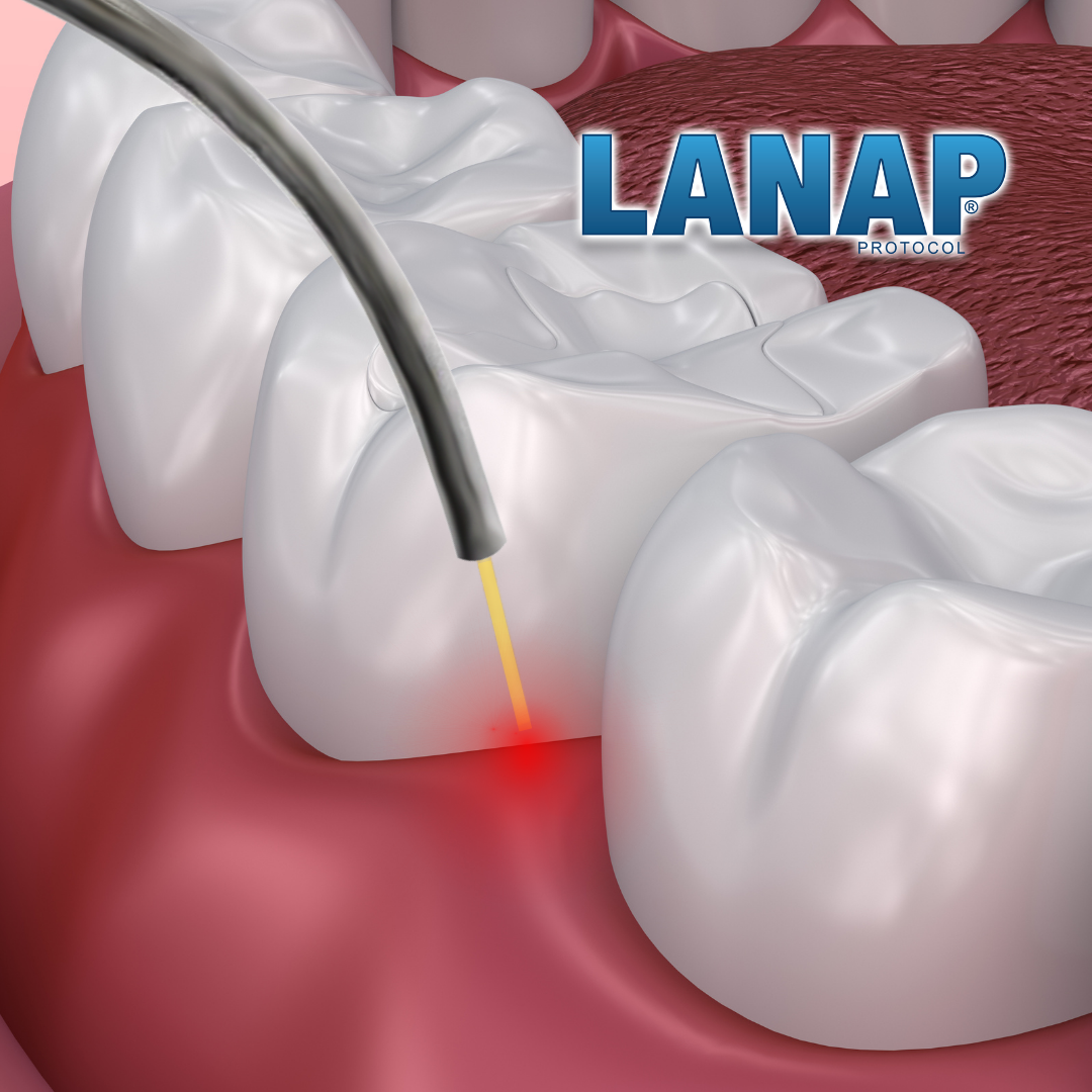 LANAP Laser Treatment | Hope for Hopeless Teeth™